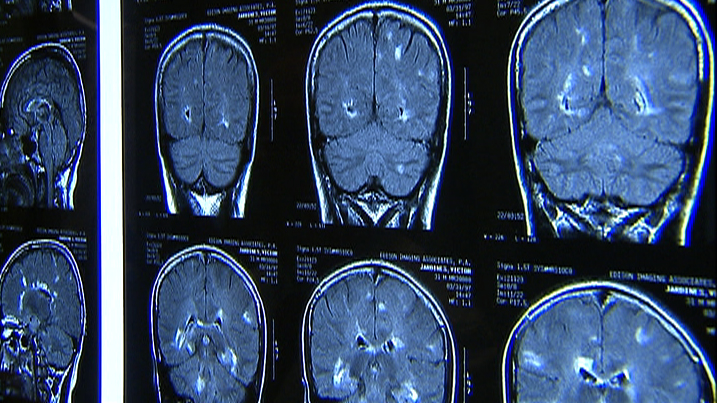 New treatment for multiple sclerosis
