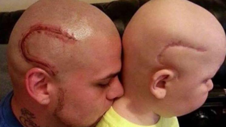 Dad gets tattoo to match son's cancer scar
