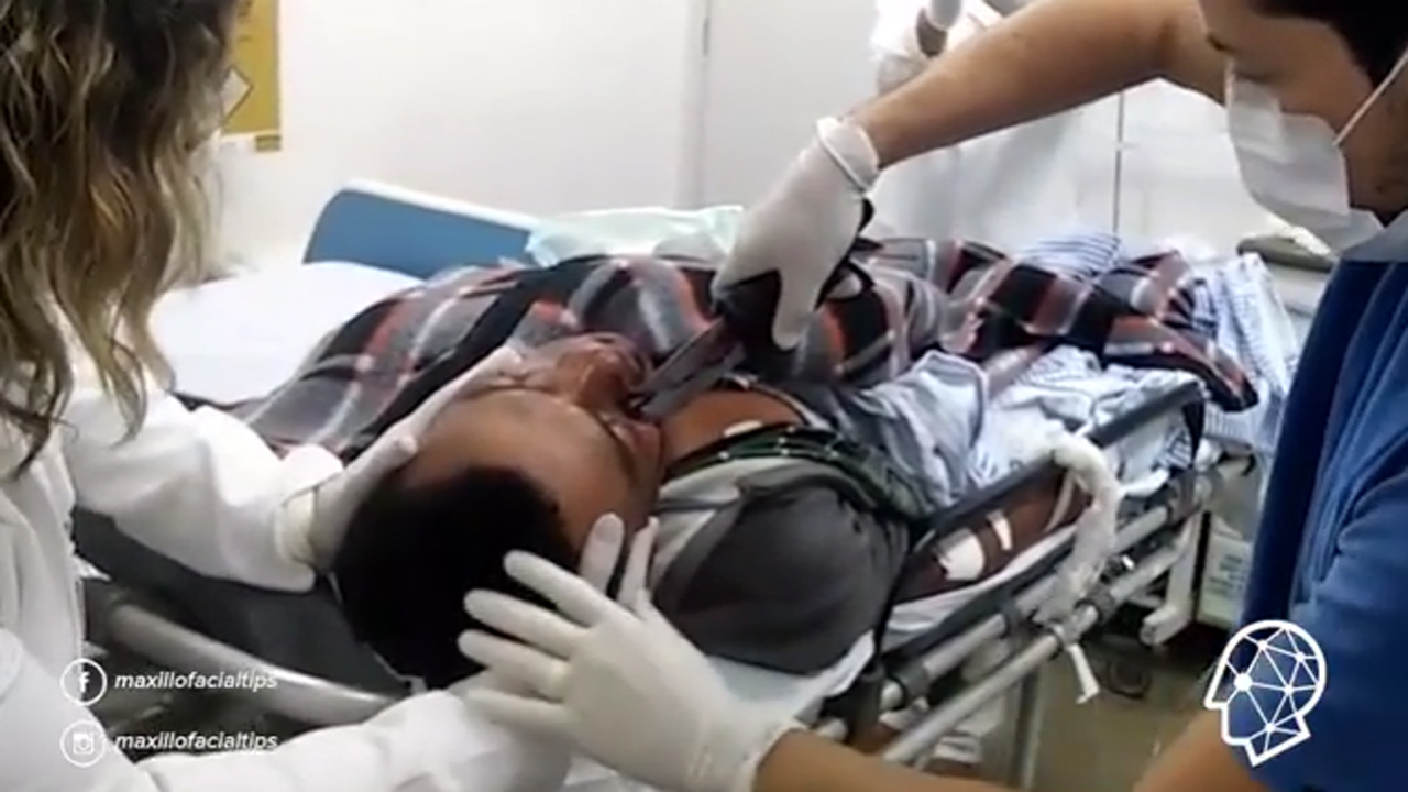Warning, graphic video: Doctor yanks knife from man's face