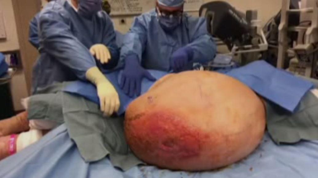 Doctors stunned by 140lb tumor growing inside PA woman