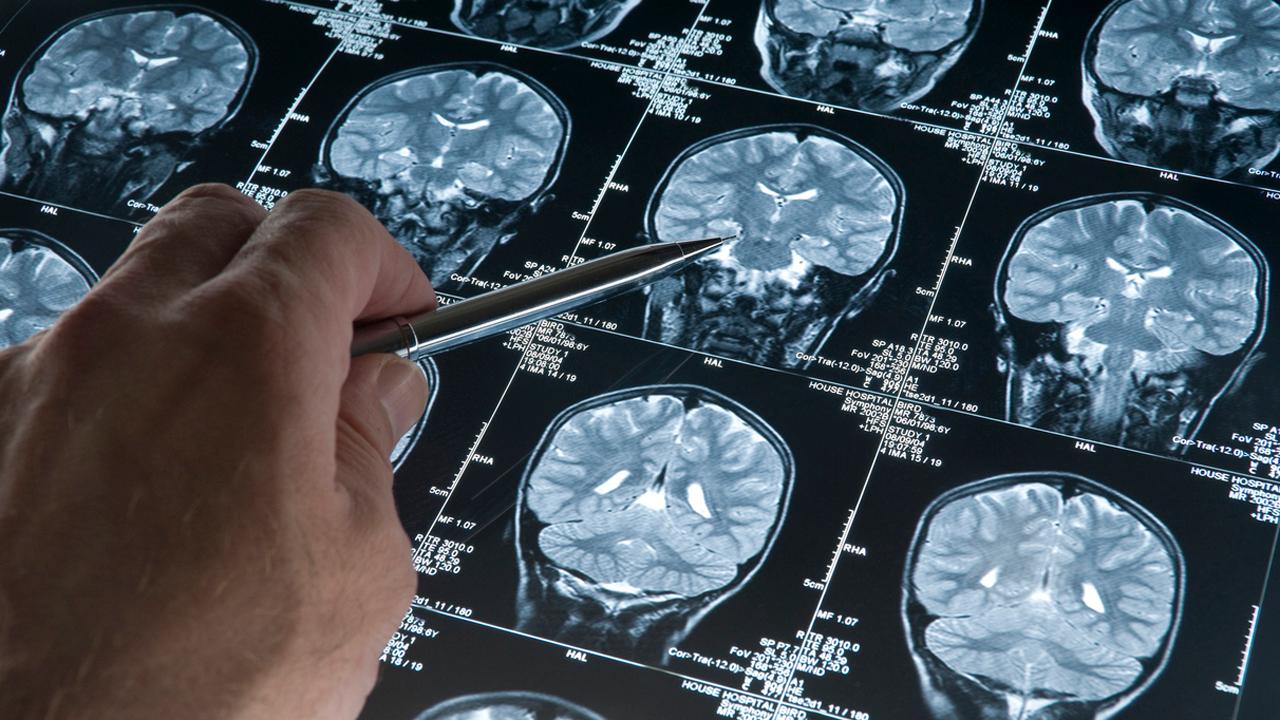 Scientists can now predict age Alzheimer’s disease sets in