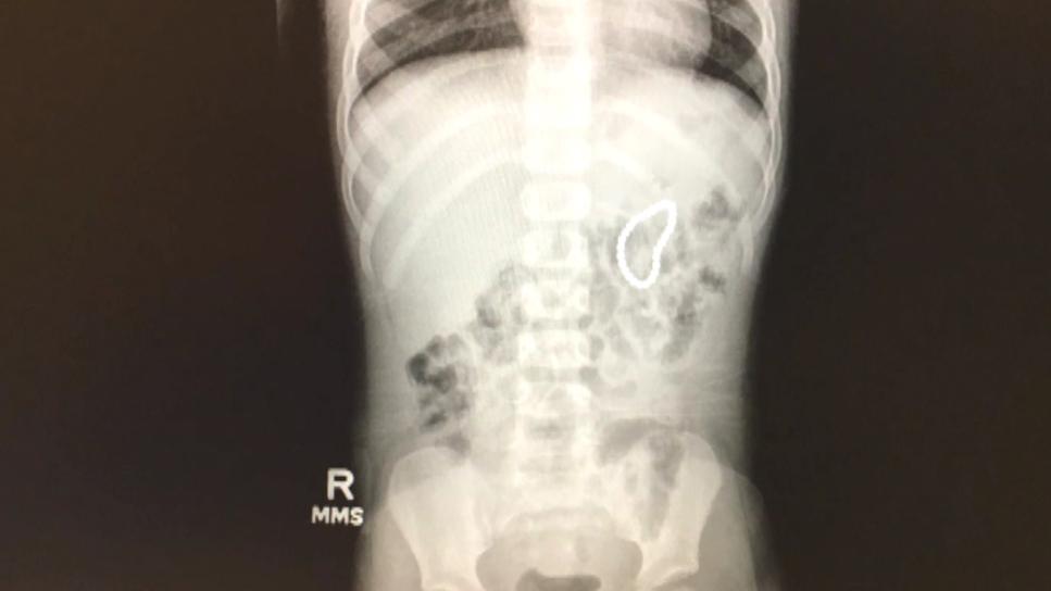 Surgeons remove 28 magnets from 2-year-old's bowel