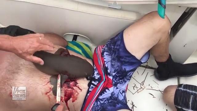 Nurse shark bites man's stomach and refuses to let go