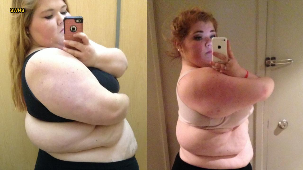 Obese high school student who attempted suicide drops 157 pounds