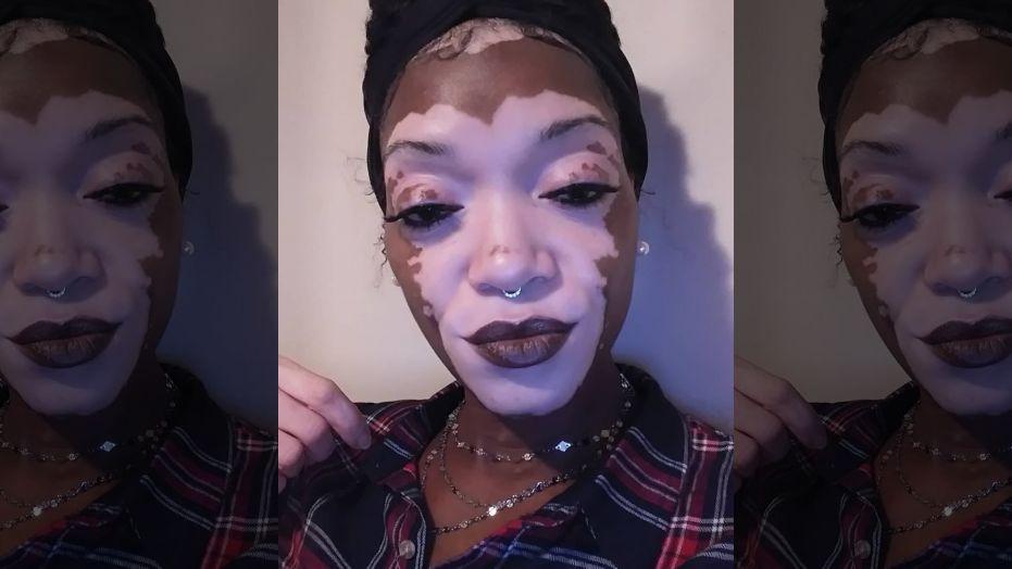 A woman with vitiligo goes makeup-free after 30 years of 'wearing a mask'