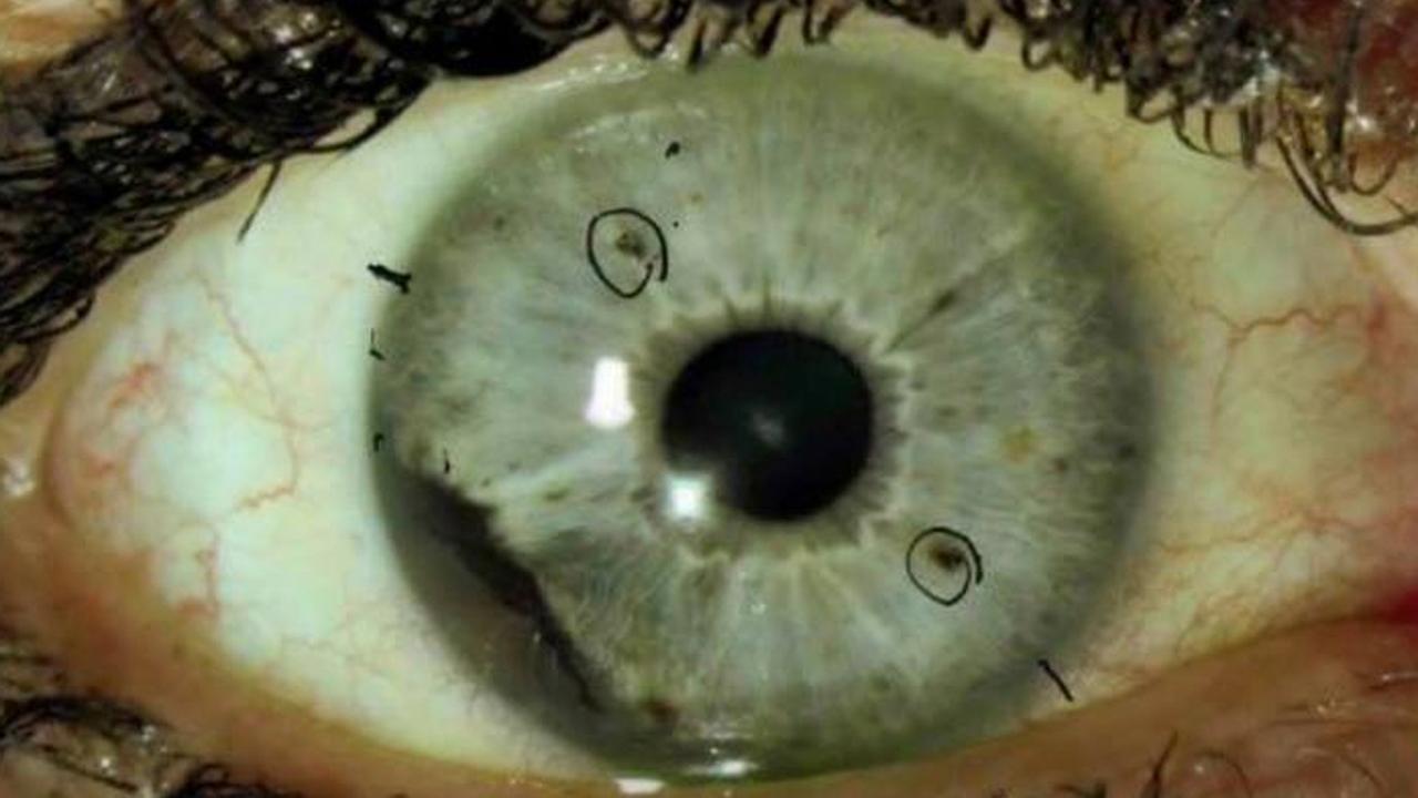 What is ocular melanoma?