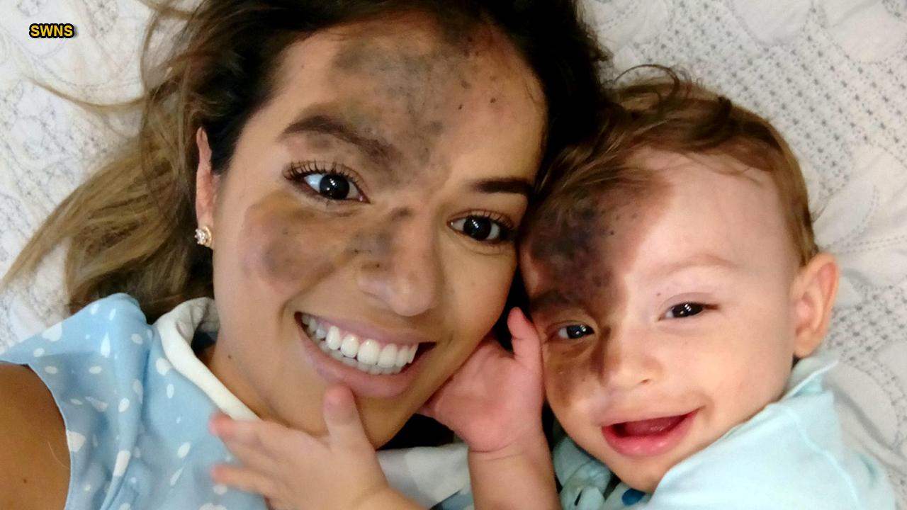 Mom gets birthmark painted on face to match young son