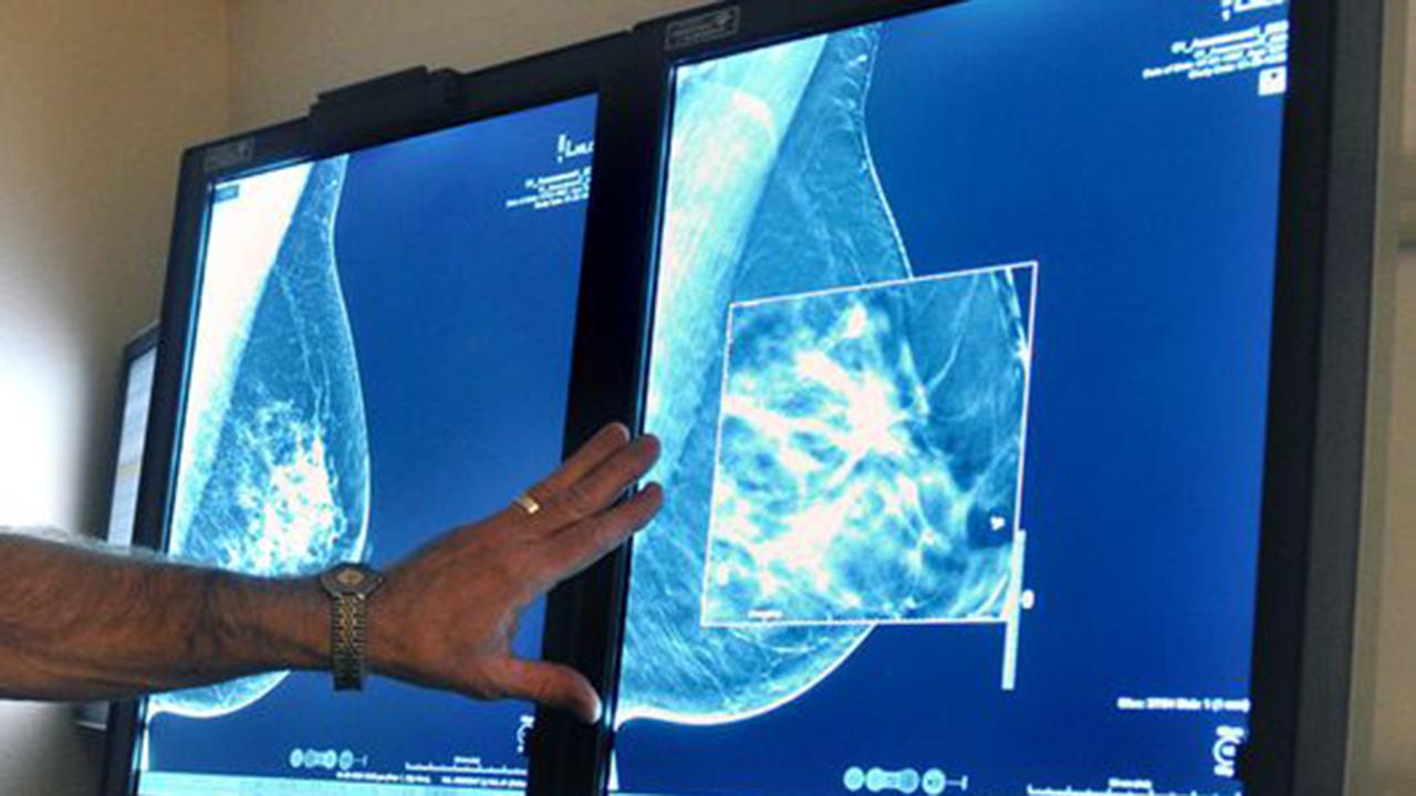 70% of early-stage breast cancer cases could skip chemo
