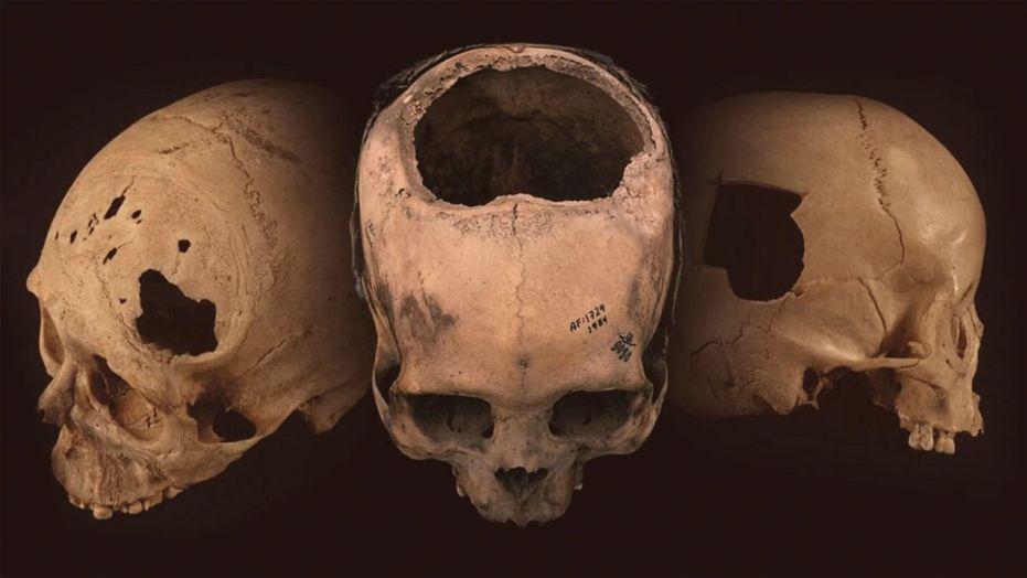 Incas mastered the practice of drilling holes in skulls
