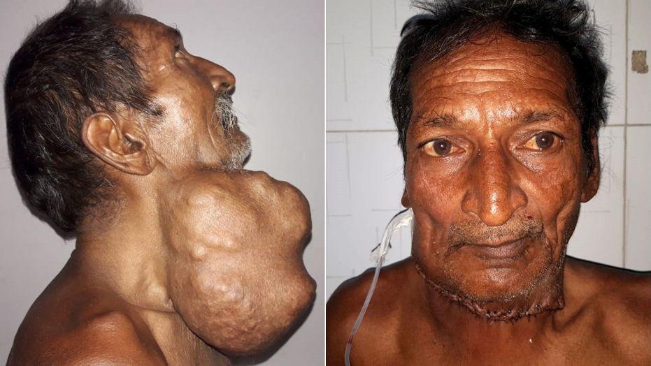 Man gets a 3-pound tumor removed from his neck
