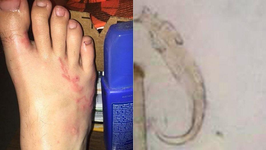 Viva Voluntary Brown Teen infected with hookworms could 'feel the worms moving in his body,' mom  says | Fox News
