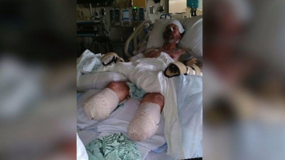Man’s limbs amputated after dog lick leads to severe infection