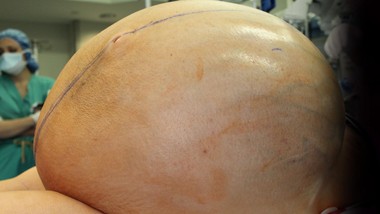 Medical team removes 132-pound ovarian tumor from woman