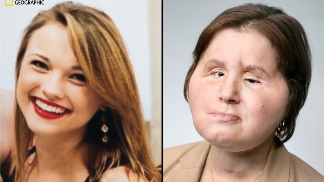 Girl receives ‘face transplant’ after suicide attempt   