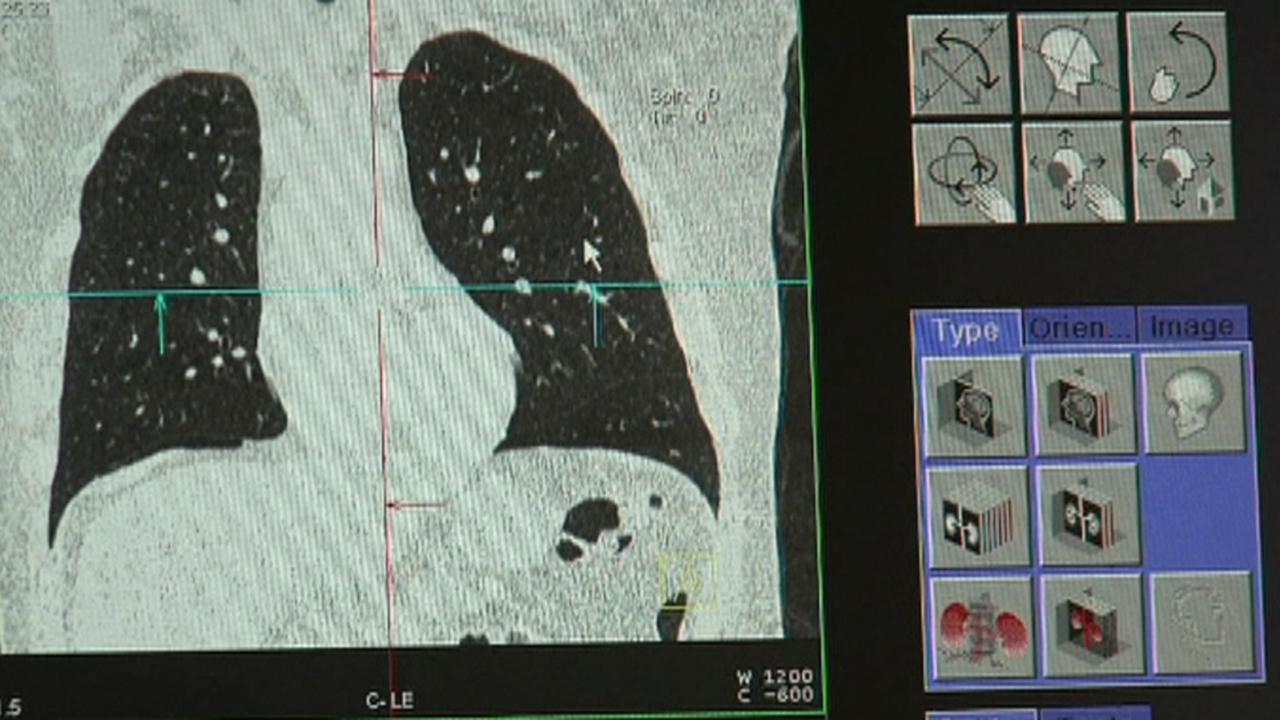 New scan can predict your heart attack risk
