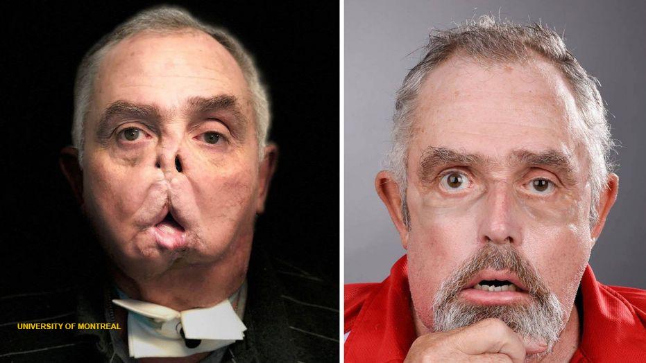 Canadian undergoes face transplant after tragic accident