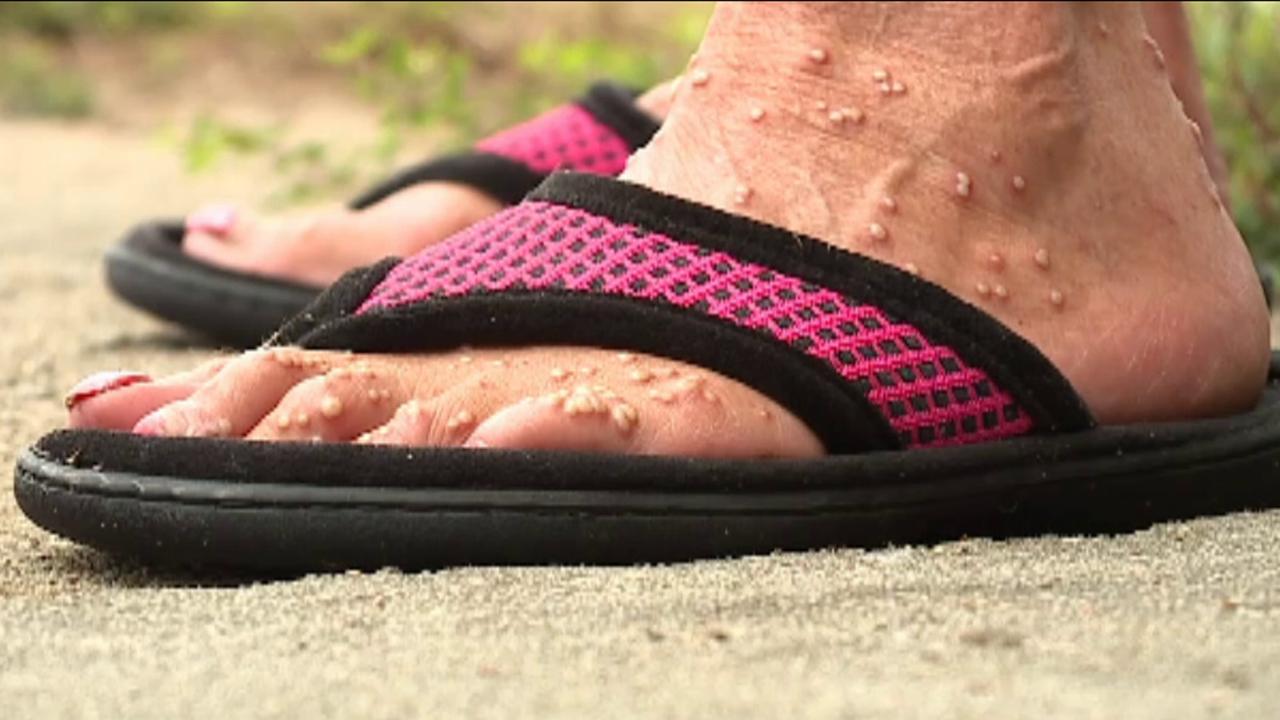 North Carolina woman almost killed by fire ants
