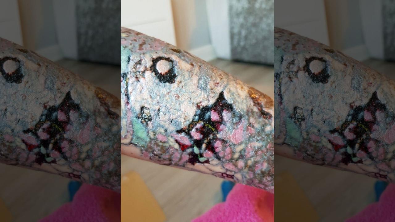 UK mom claims tattoo removal left her with horrific infection