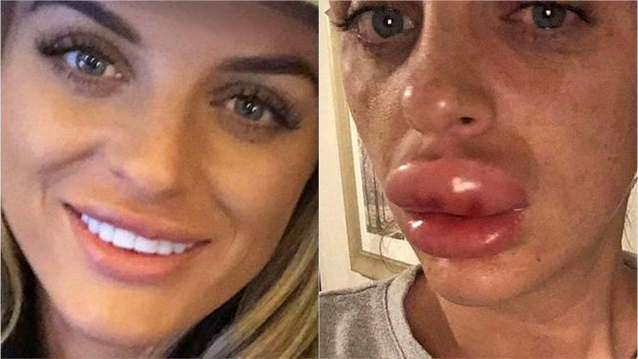British woman almost loses lip at 'botox party'