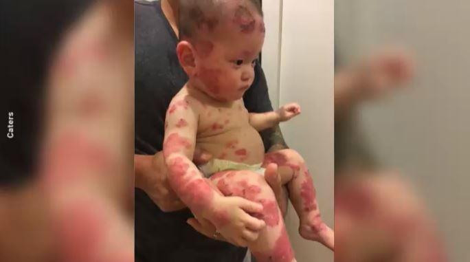 Toddler overcoming agonizing reaction to steroid creams