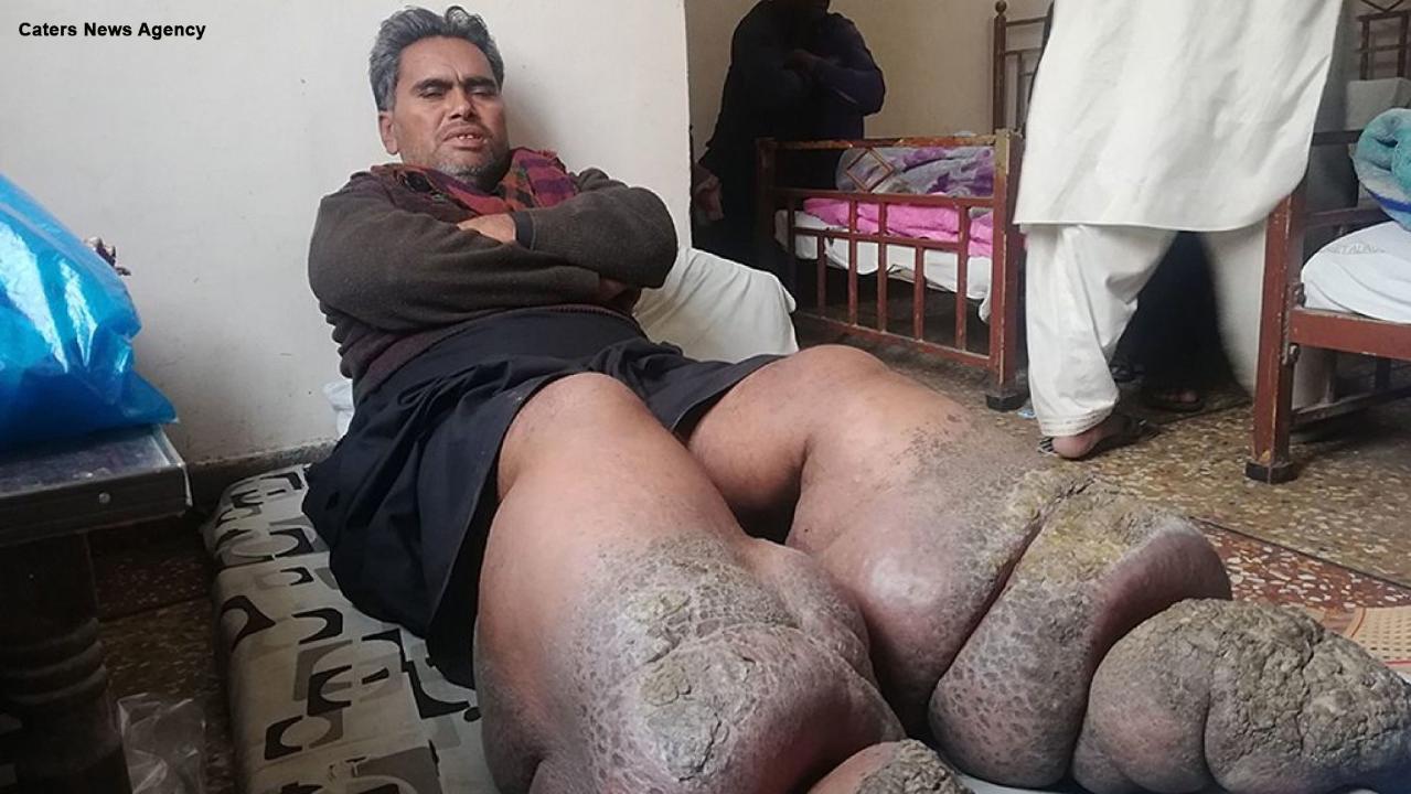Infection causes man’s legs to swell up to over 100 pounds