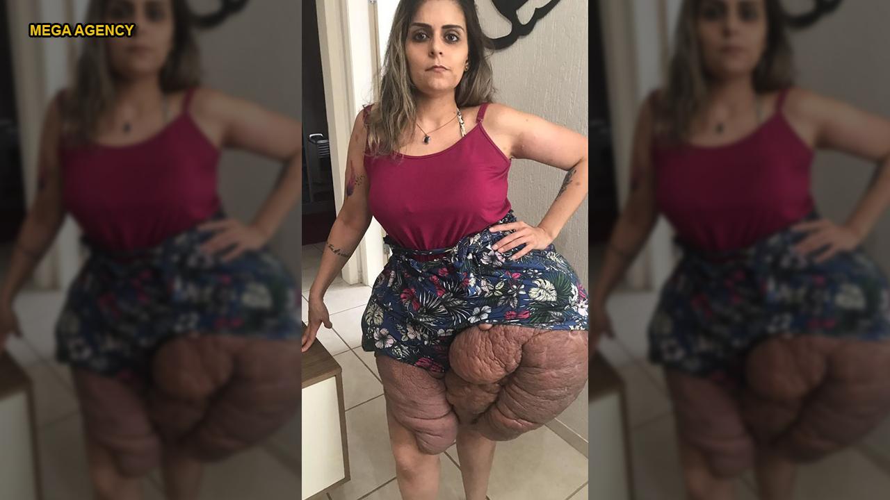 Woman with massive tumors on legs faces incurable disorder