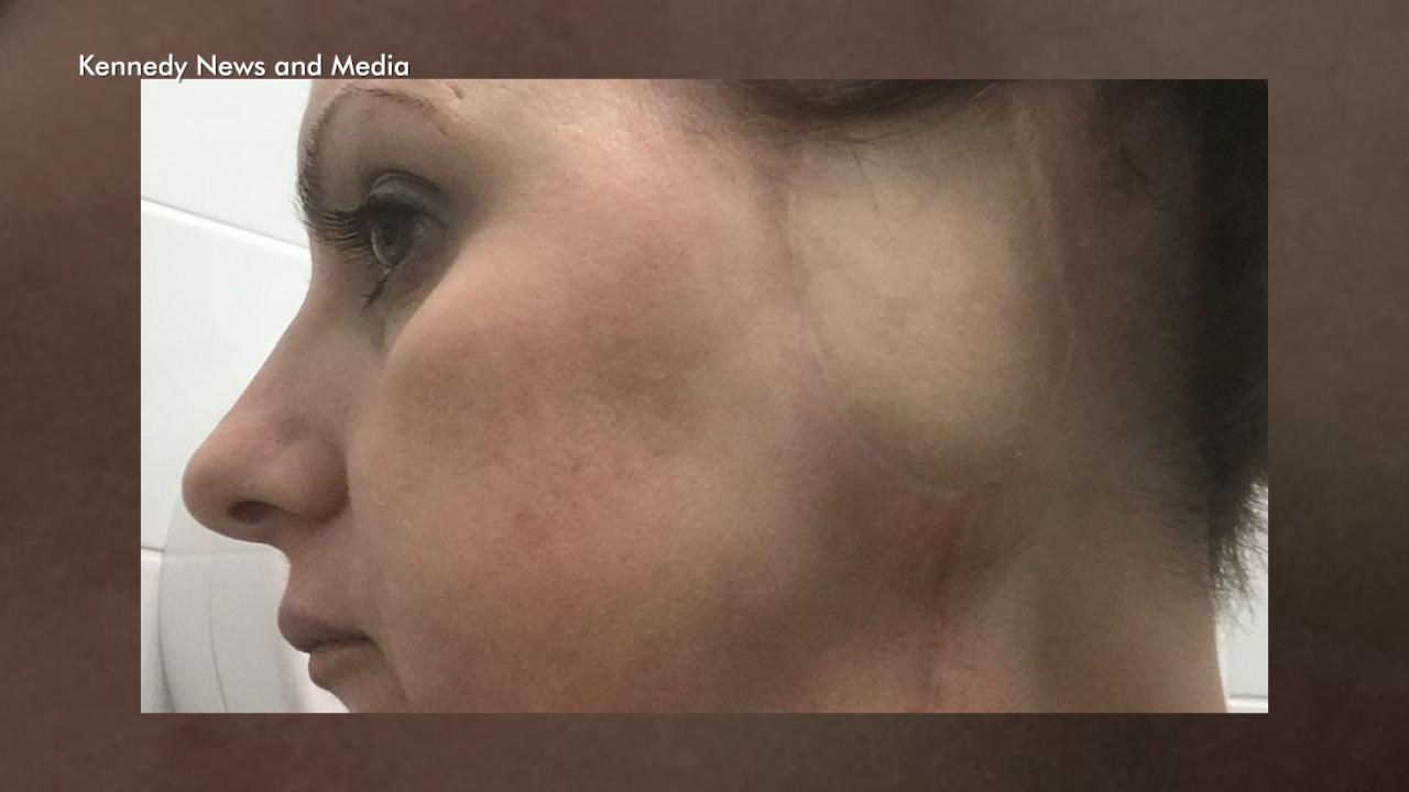 Mom blames tanning for losing ear to skin cancer