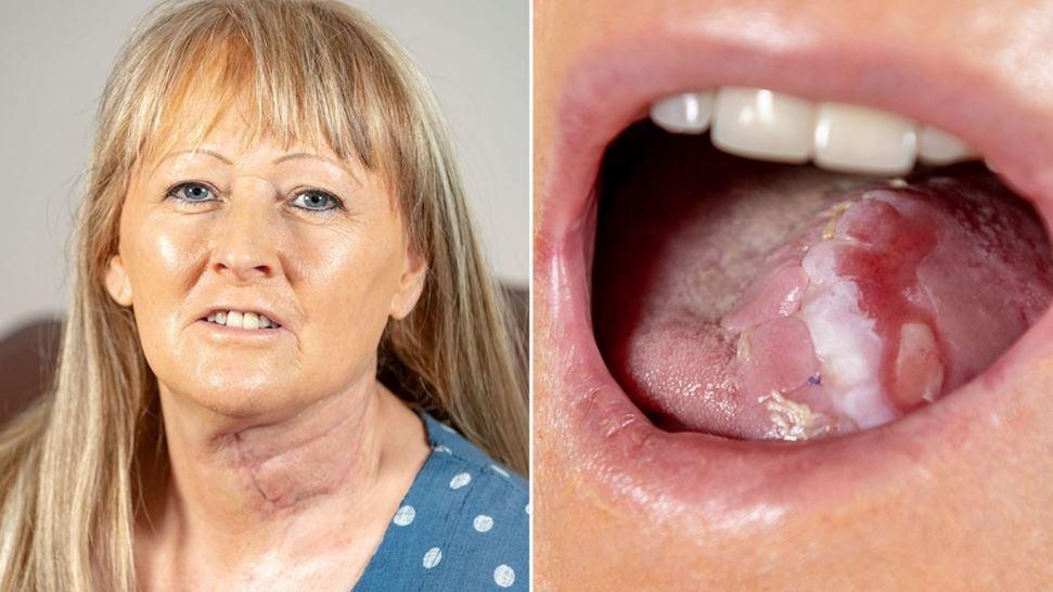 Report: 58-year-old Joanna Smith gets a new tongue made from a vein and pieces of her arm