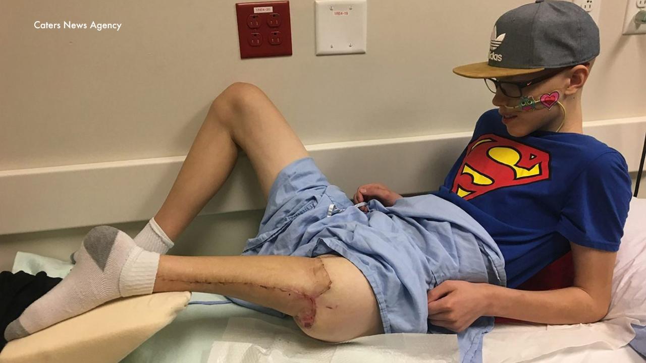 Teen's foot attached backward to form new knee after cancer surgery
