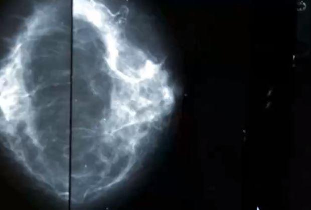 A new FDA proposal could make the first change in 20 years to its mammogram rules