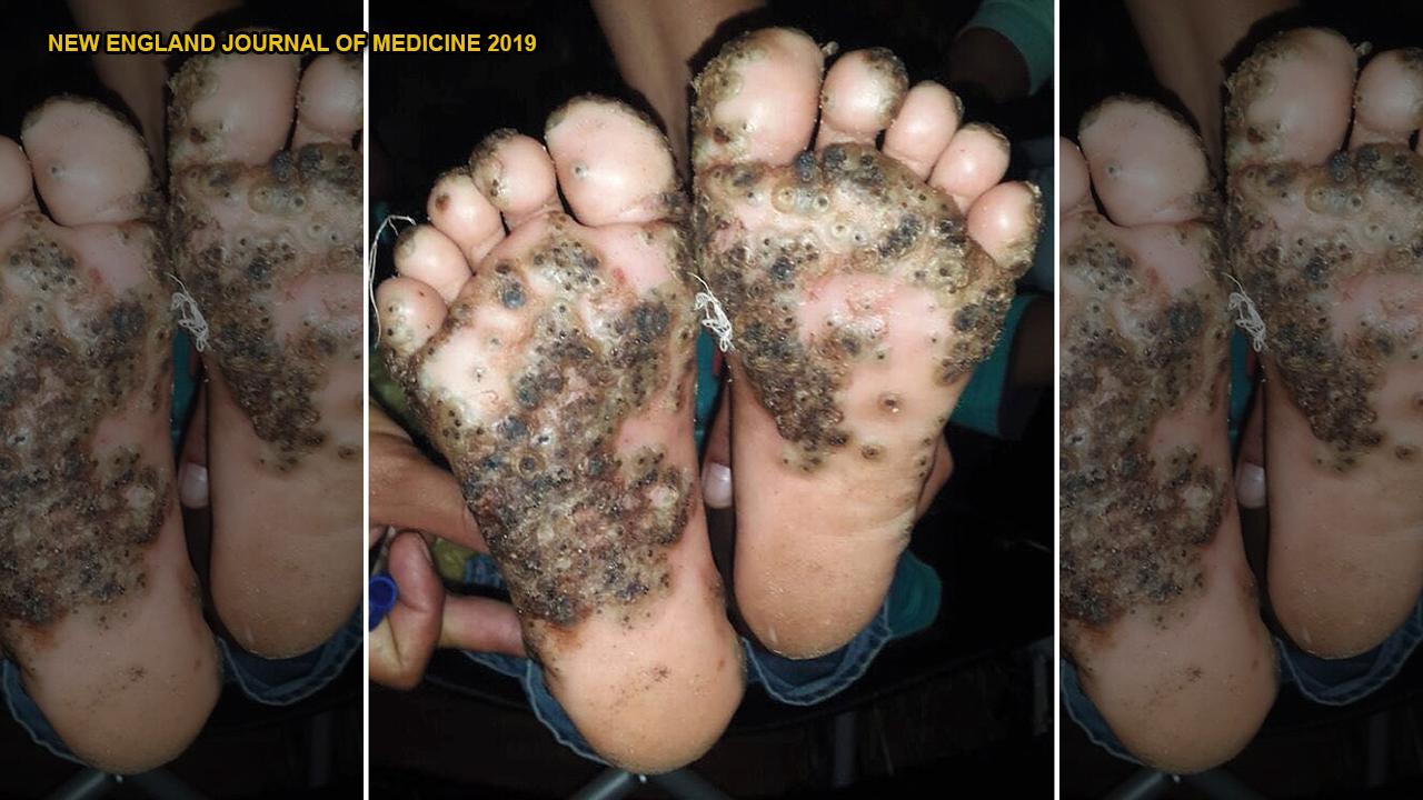 Girl's feet infested with parasitic sand fleas after running
