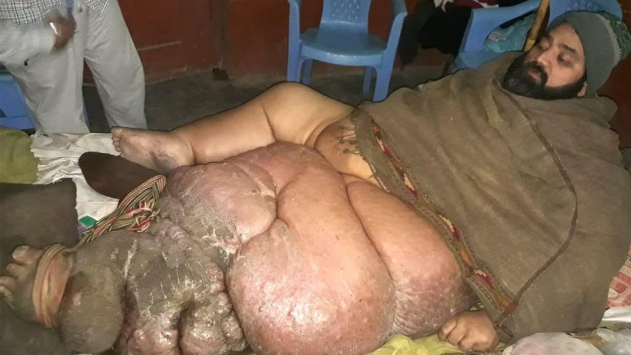 Pakistani butcher Muhammad Mushtaq is pleading for doctors to amputate his 330-pound leg