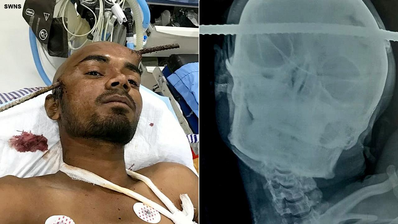 Construction worker survives after iron rod pierces through his head