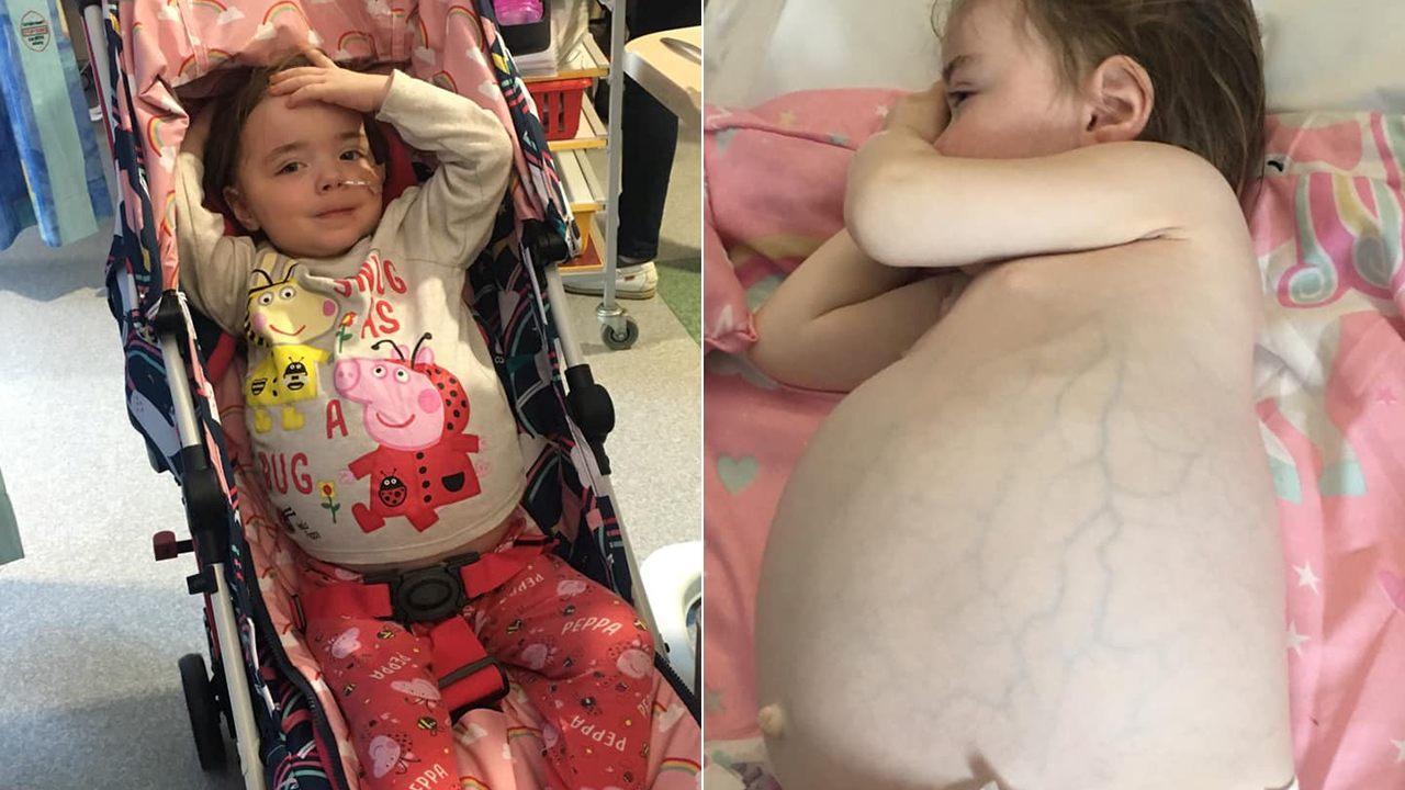 Toddler diagnosed with rare, aggressive tumor after mom noticed massive swelling in stomach
