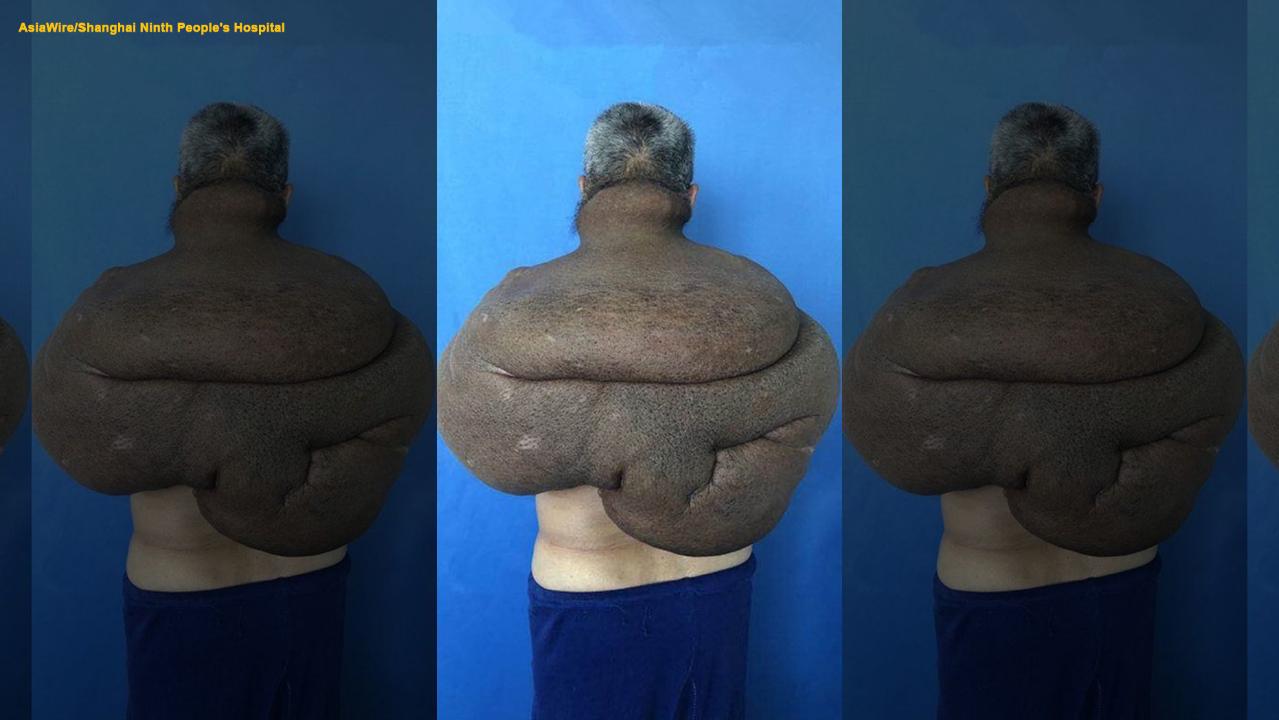 Man gets 61-pound tumor removed in 33-hour marathon surgery