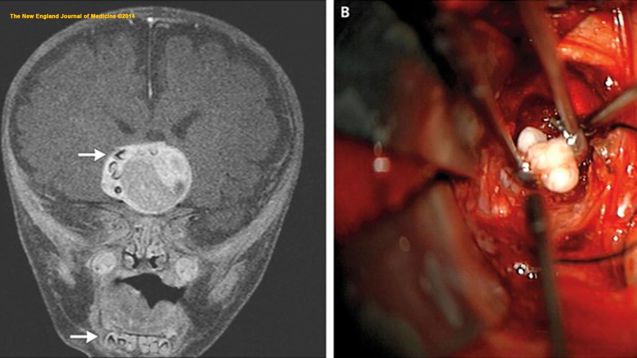 Doctors find teeth growing inside a brain tumor of a 4-month-old baby