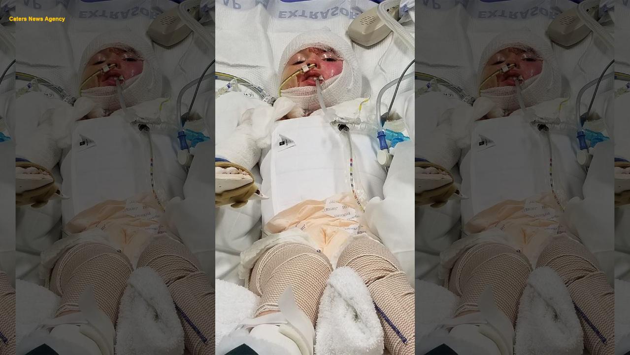 Little girl sustains horrific burns across 68 percent of her body after candle lit sofa on fire