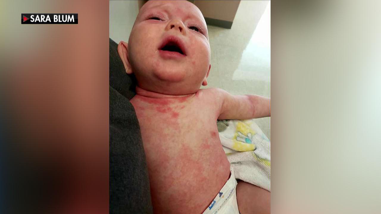 Mother shares heartbreaking photos of baby son with measles, urges people to get vaccinated