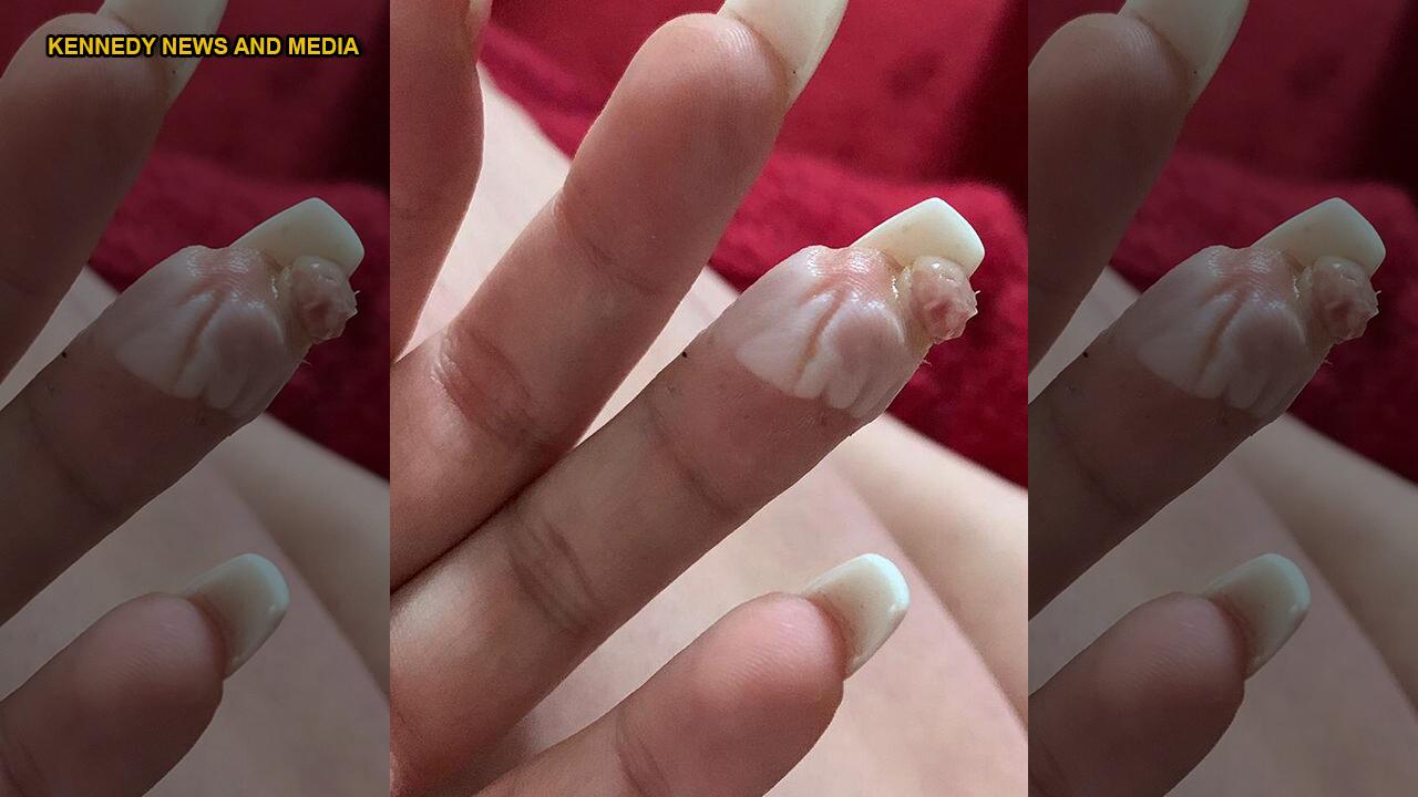 Woman claims botched acrylic nail job nearly cost her a finger