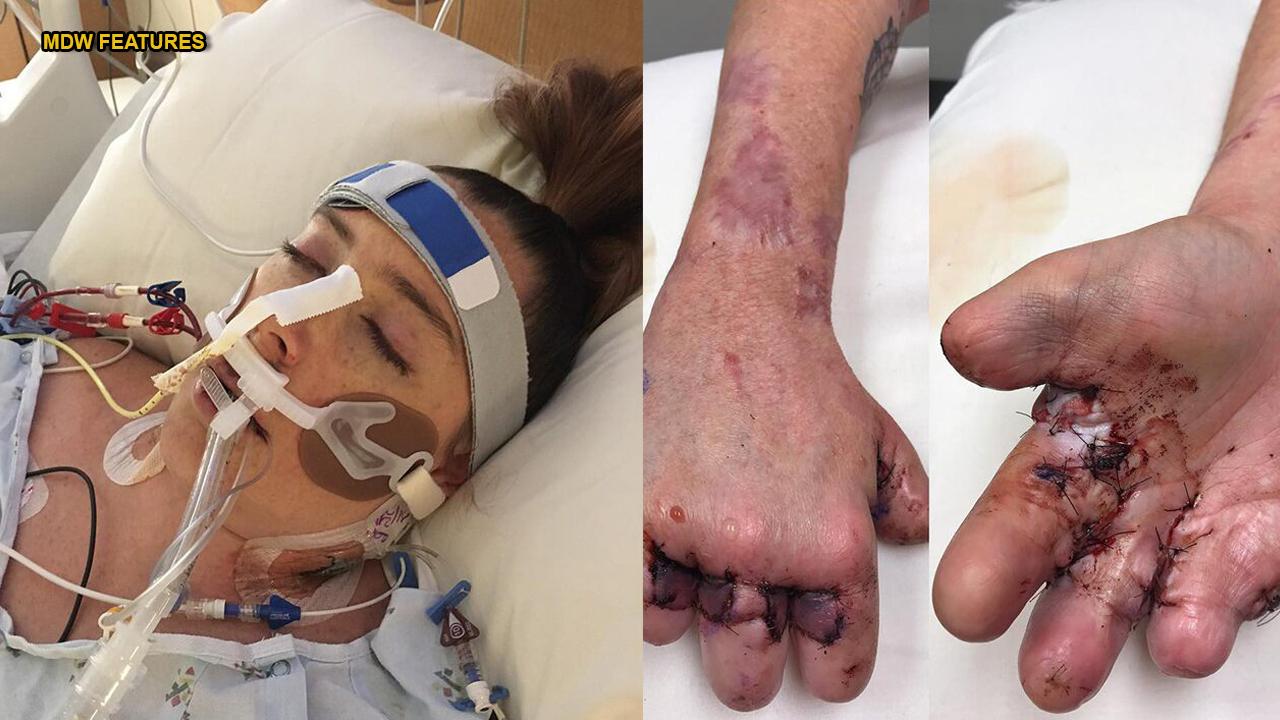 Missouri mom loses all 10 toes, hand, several fingers after battle with deadly sepsis infection