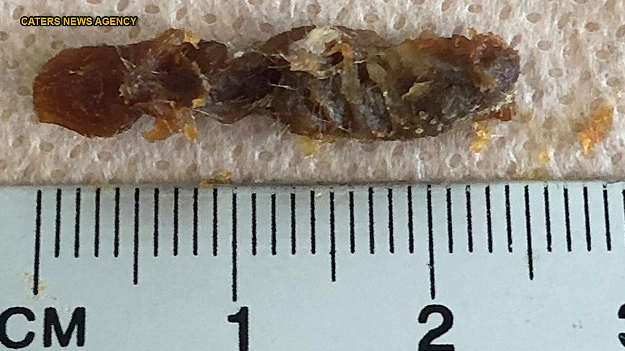 Earwax clump clogging entire ear canal removed from patient