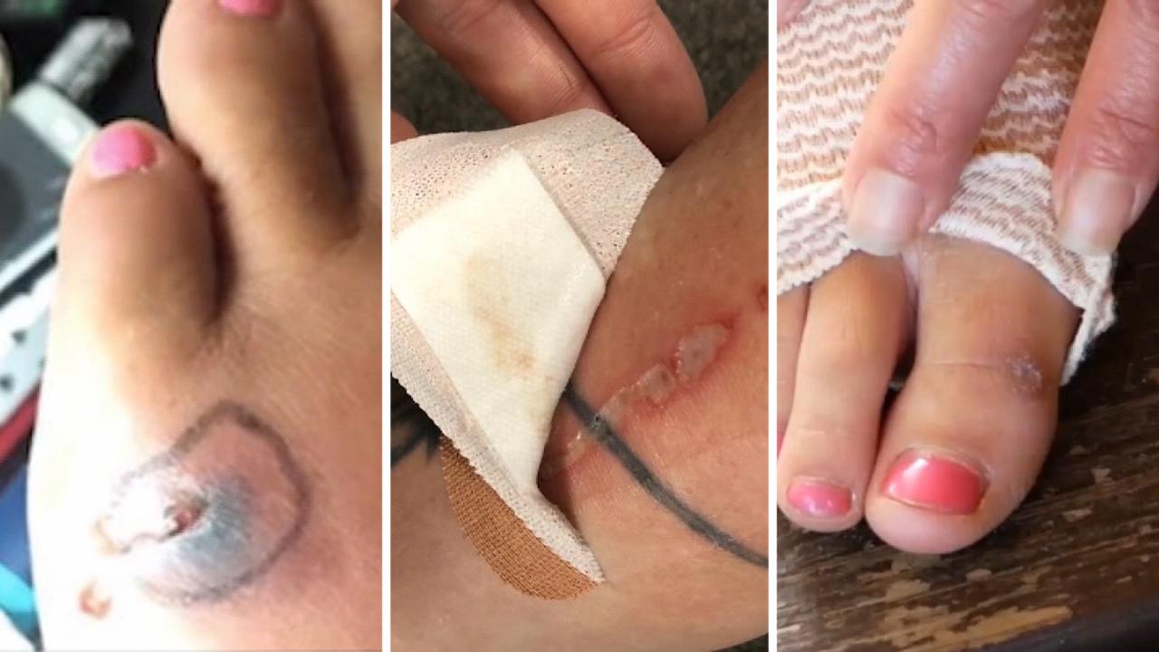 More flesh-eating bacteria cases reported in Florida