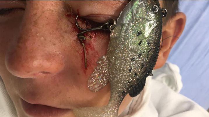 Fishing accident nearly cost boy his eye