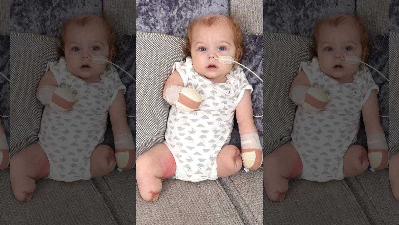 UK baby loses all 4 limbs following horrific sepsis infection