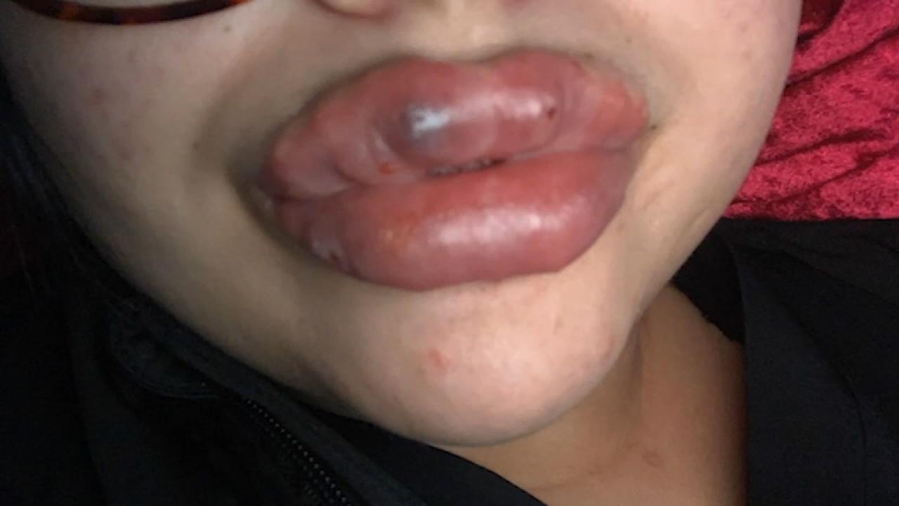 Several women claim botched lip injections caused severe infection 