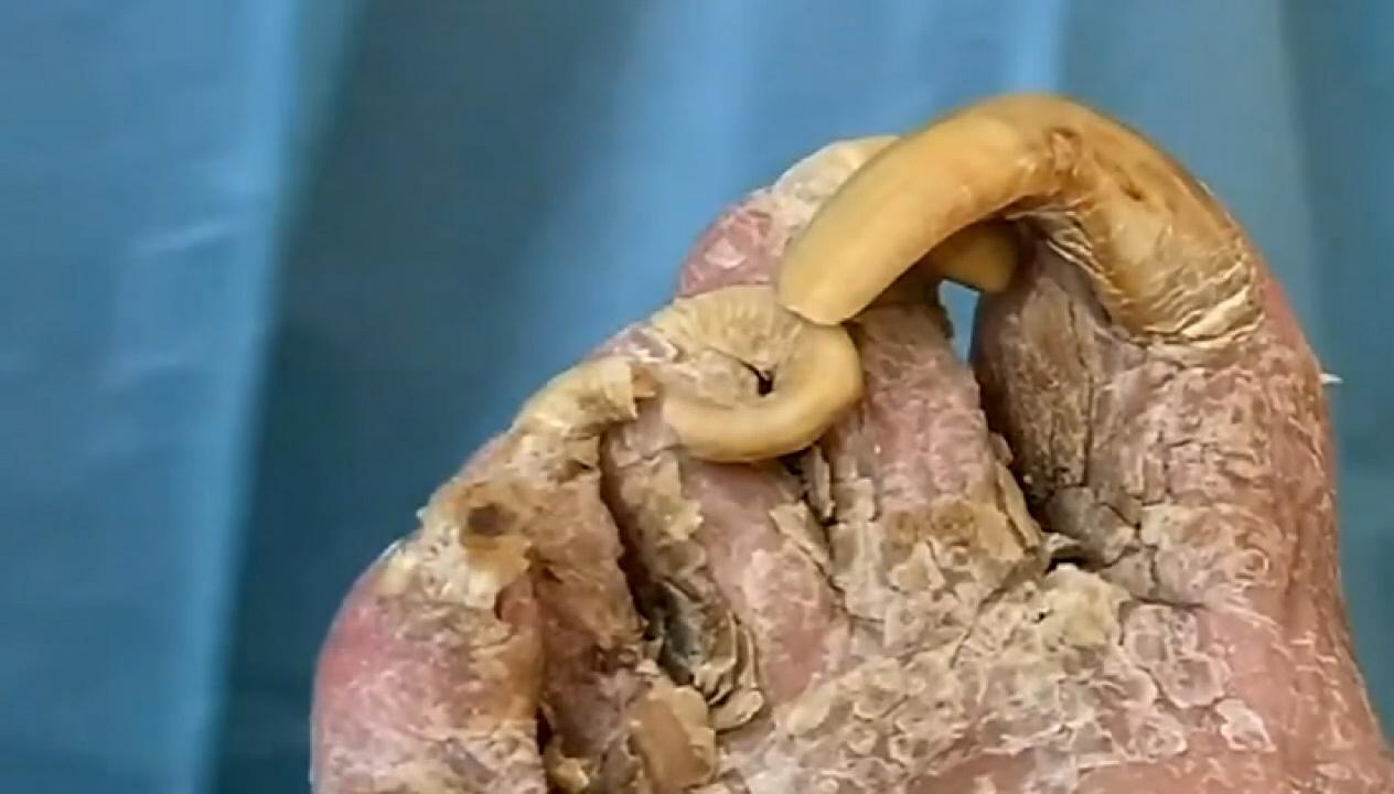 Florida podiatrist cuts patient’s giant infected toenails