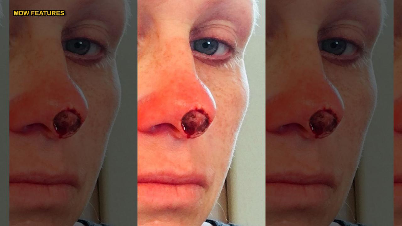 Mother left with hole in her face mistaking cancer for spot