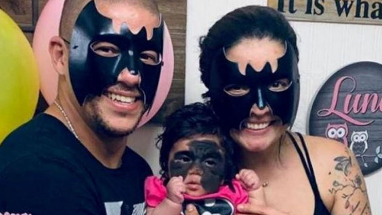 7-month-old infant heads to Russia to have ‘Batman’ mask markings treated