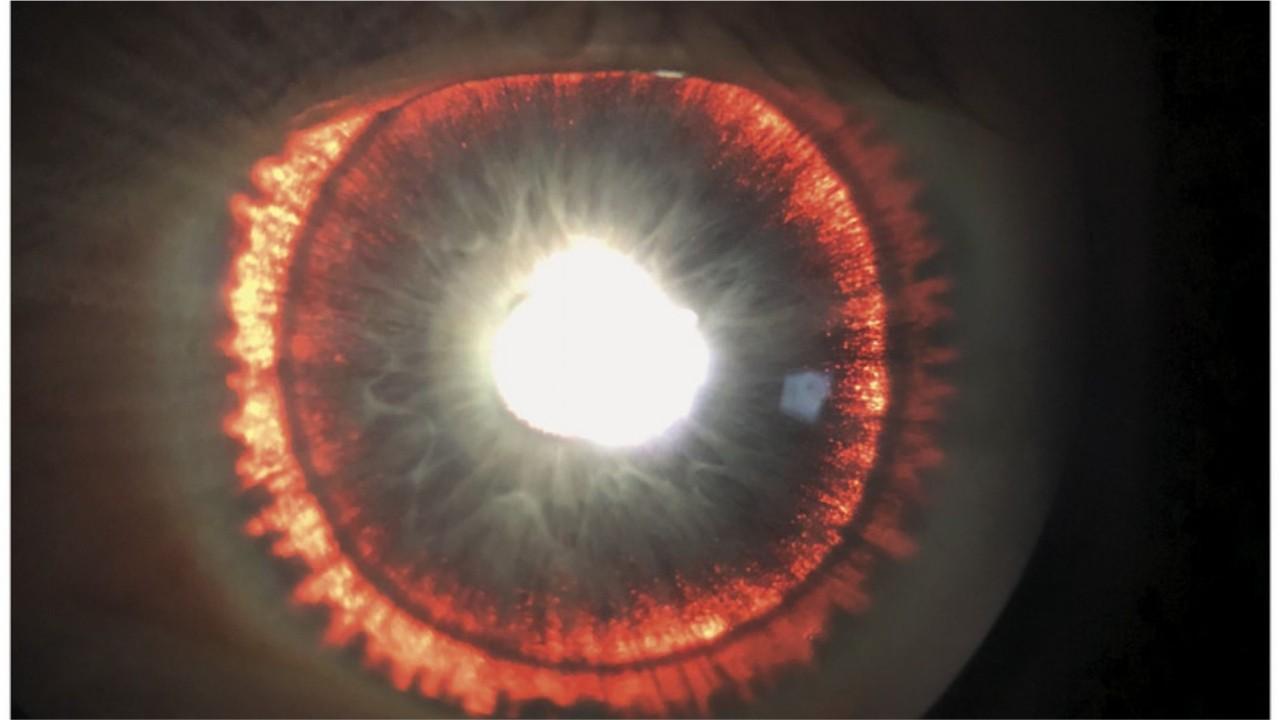 Rare syndrome causes man’s eye to 'glow'