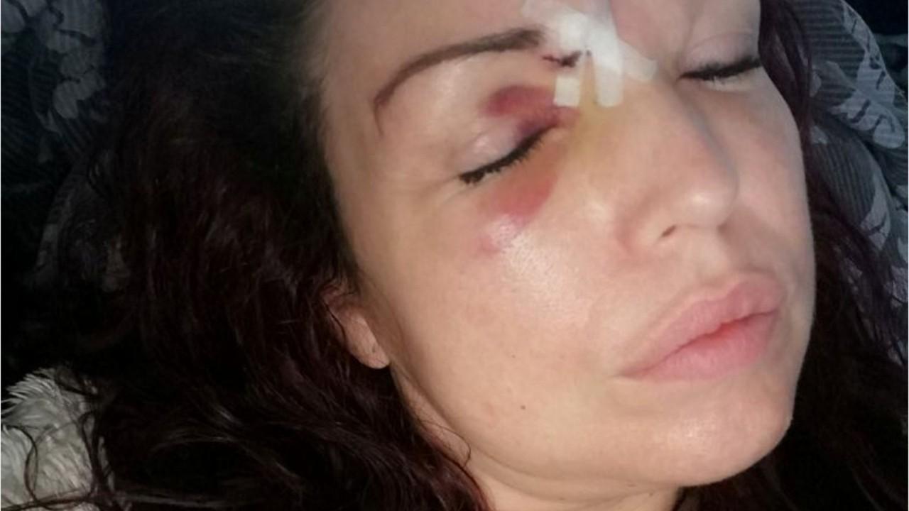 Mom says she nearly lost eye after Christmas present she bought son shot into face